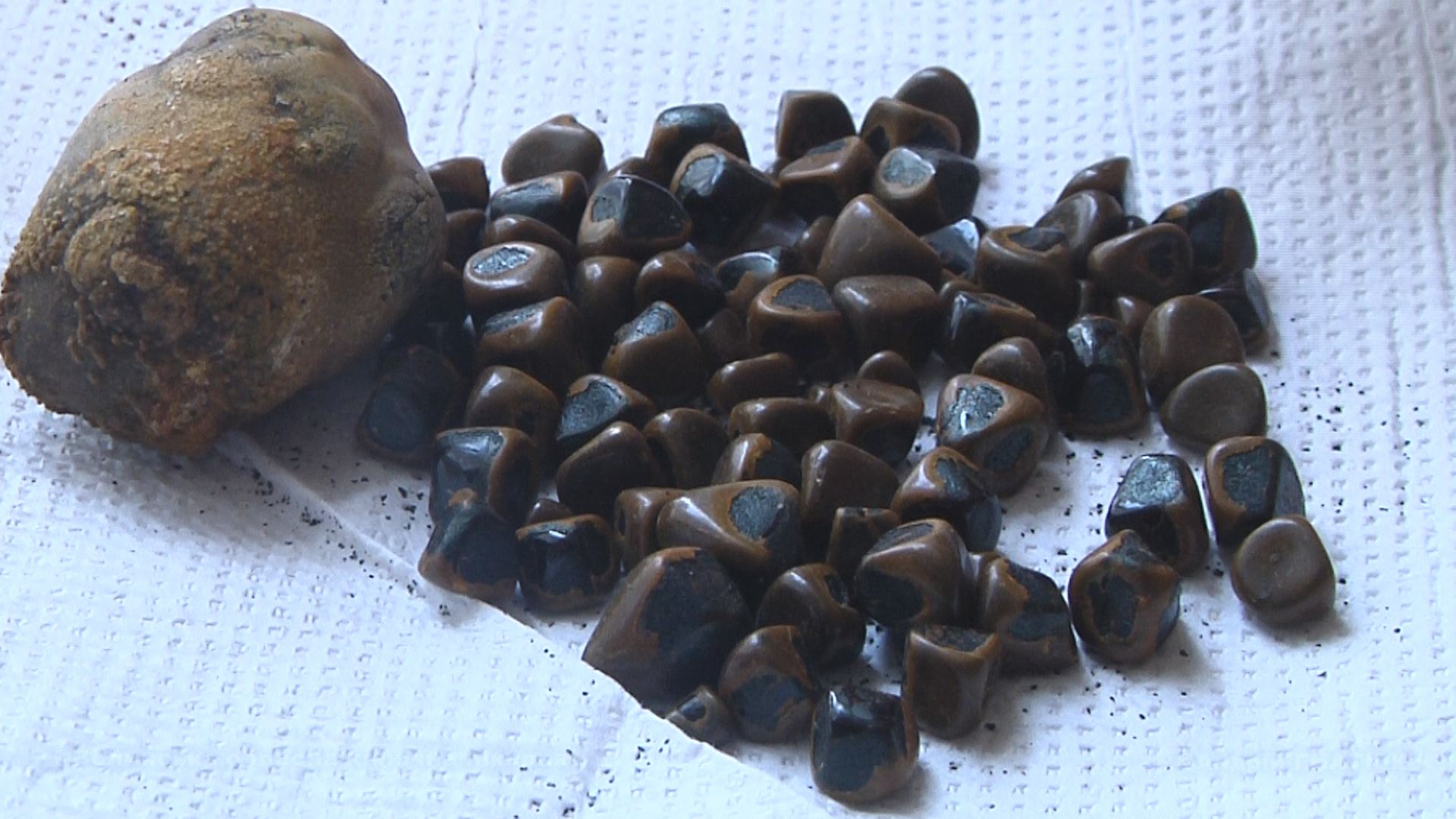 Волинянці видалили жовчний міхур, в якому був 81 камінь