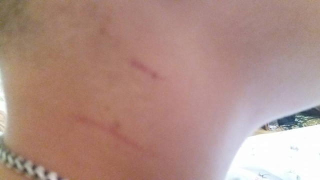 На фото - сліди на шиї в дитини