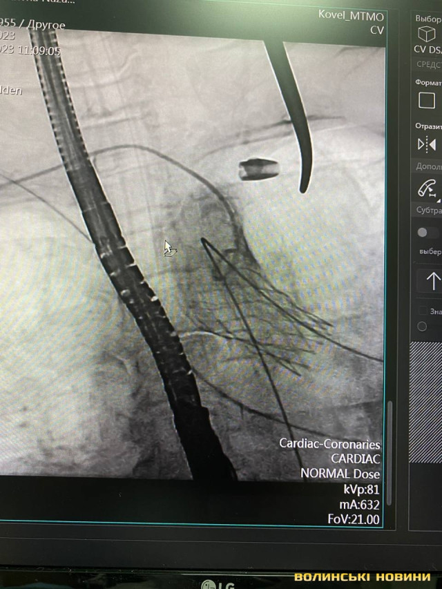 Знімок клапана уже в серці